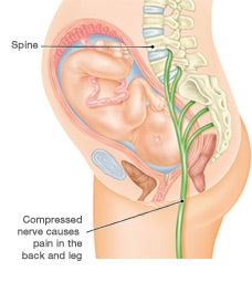 Natural Ways To Treat Sciatica Pain During Pregnancy